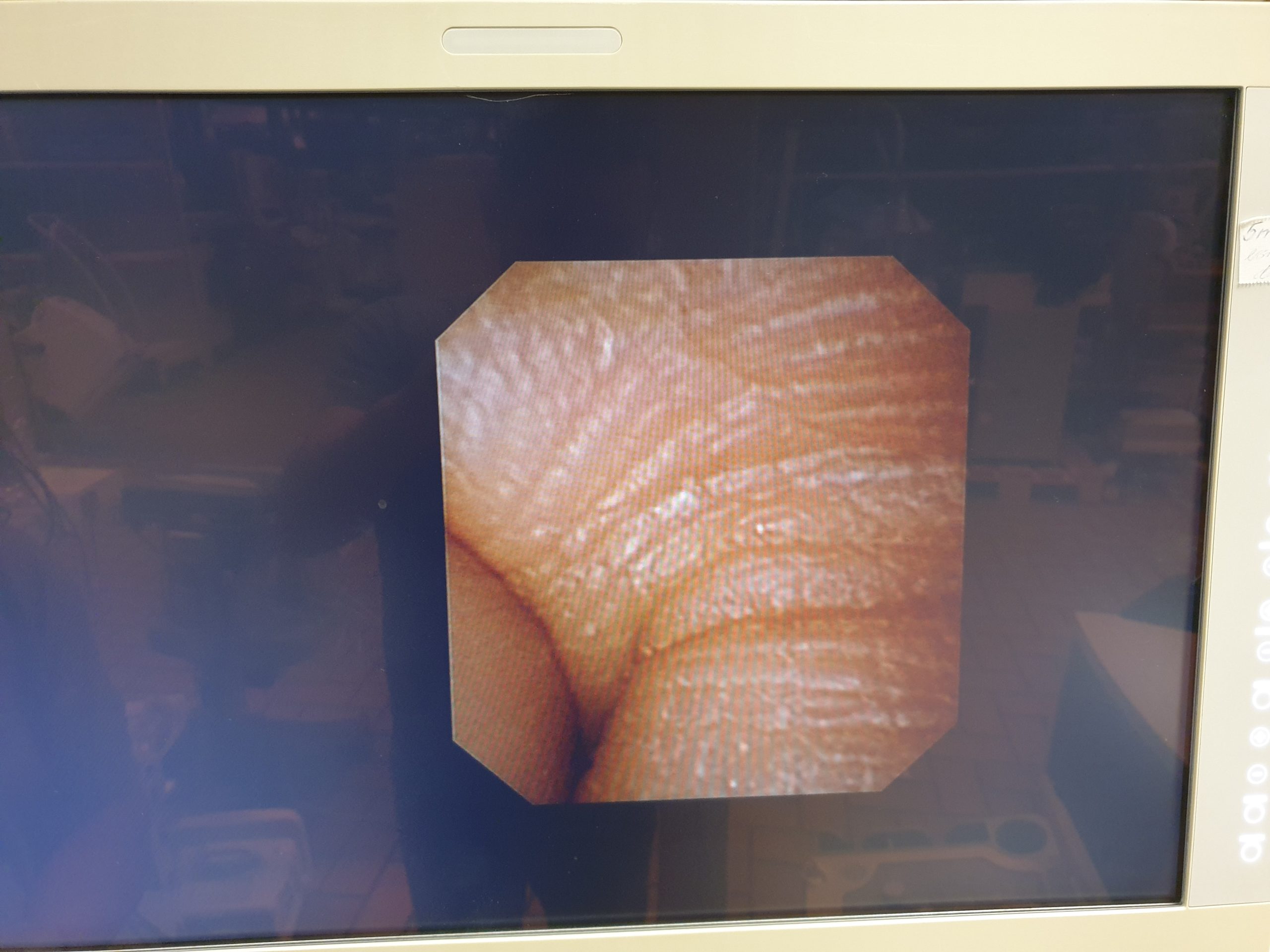 Olympus URF Type V Ureteroscope – Uretososkop thumbnail 5