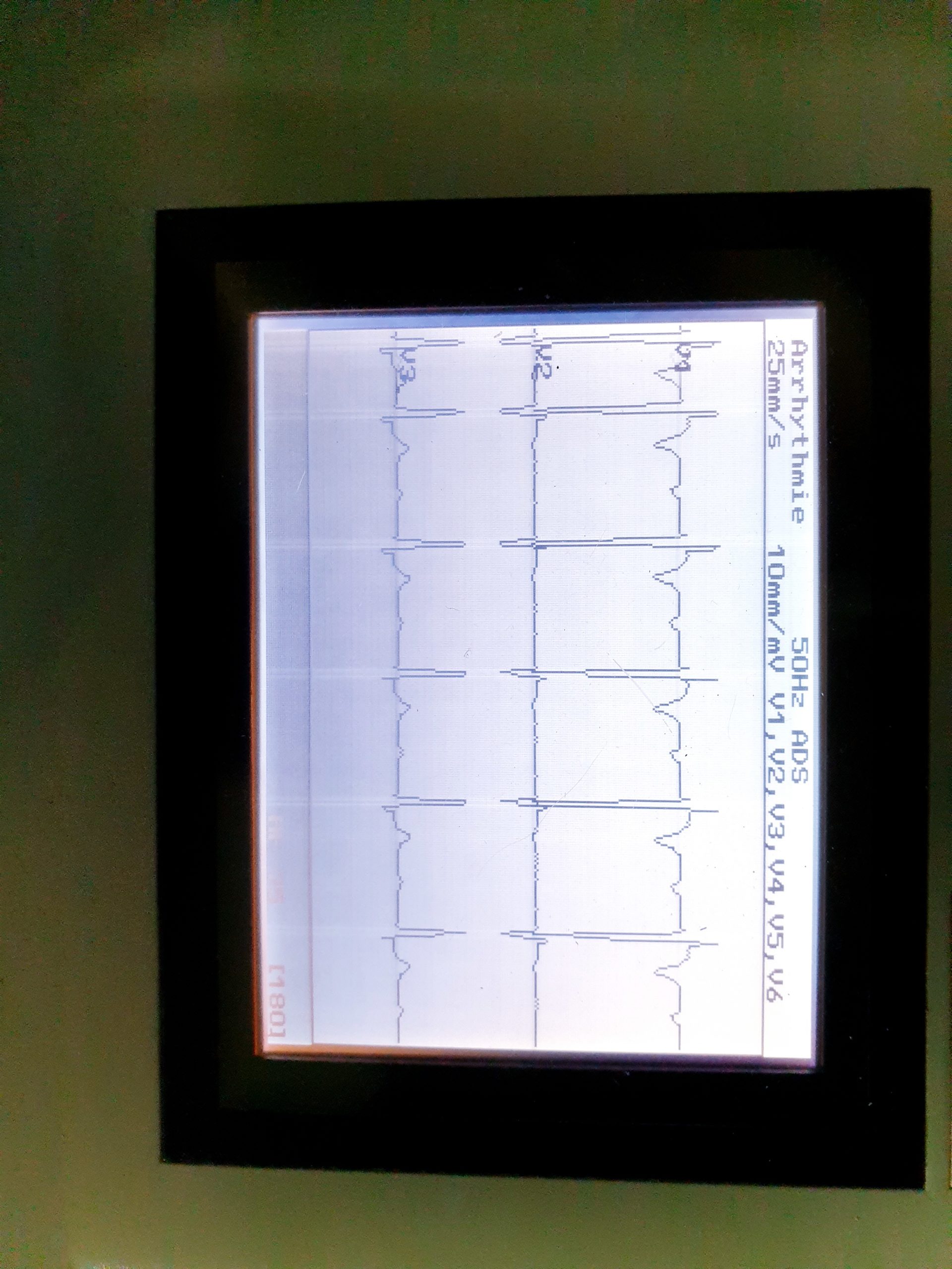 GE MAC 1200ST 1200 ST EKG Gerät mit Ableitungskabel thumbnail 3