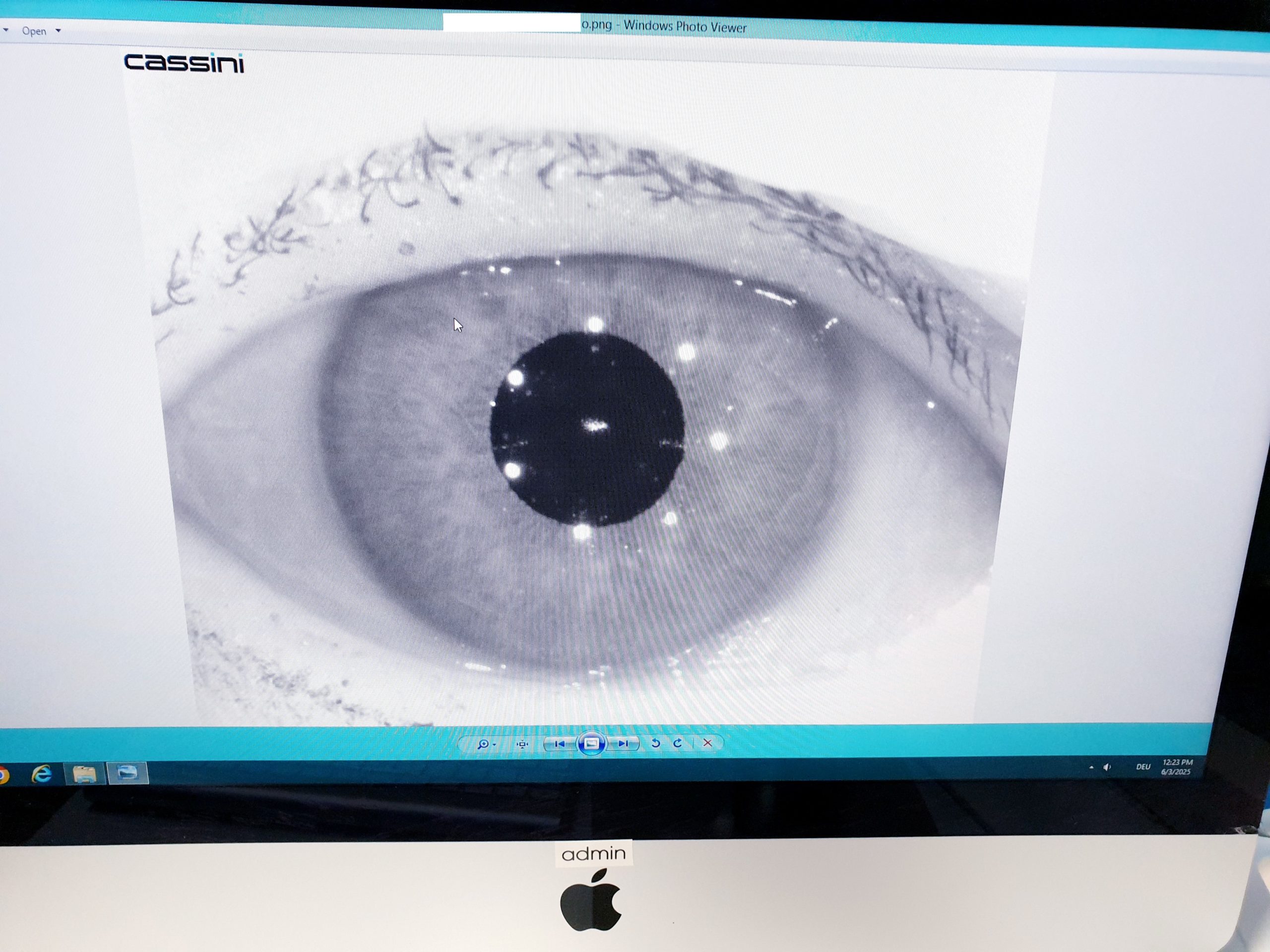 Cassini Corneal Topographer Type A total corneal astigmatism thumbnail 9