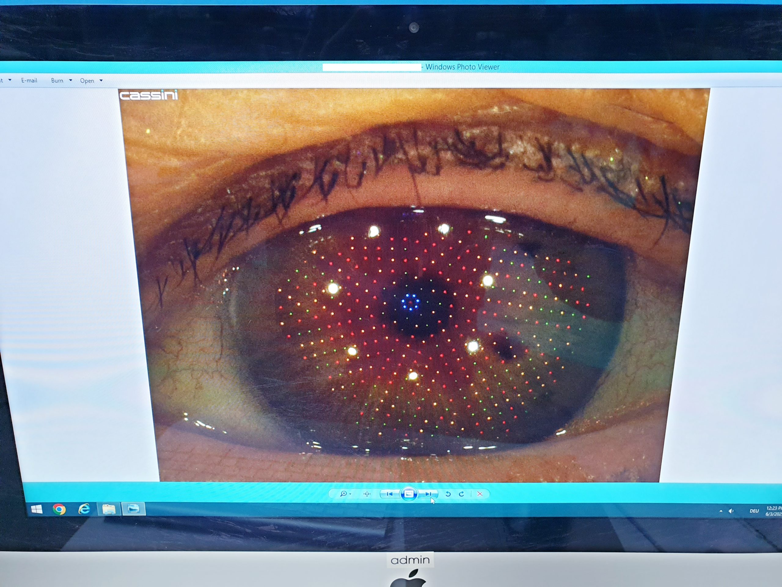Cassini Corneal Topographer Type A total corneal astigmatism thumbnail 10