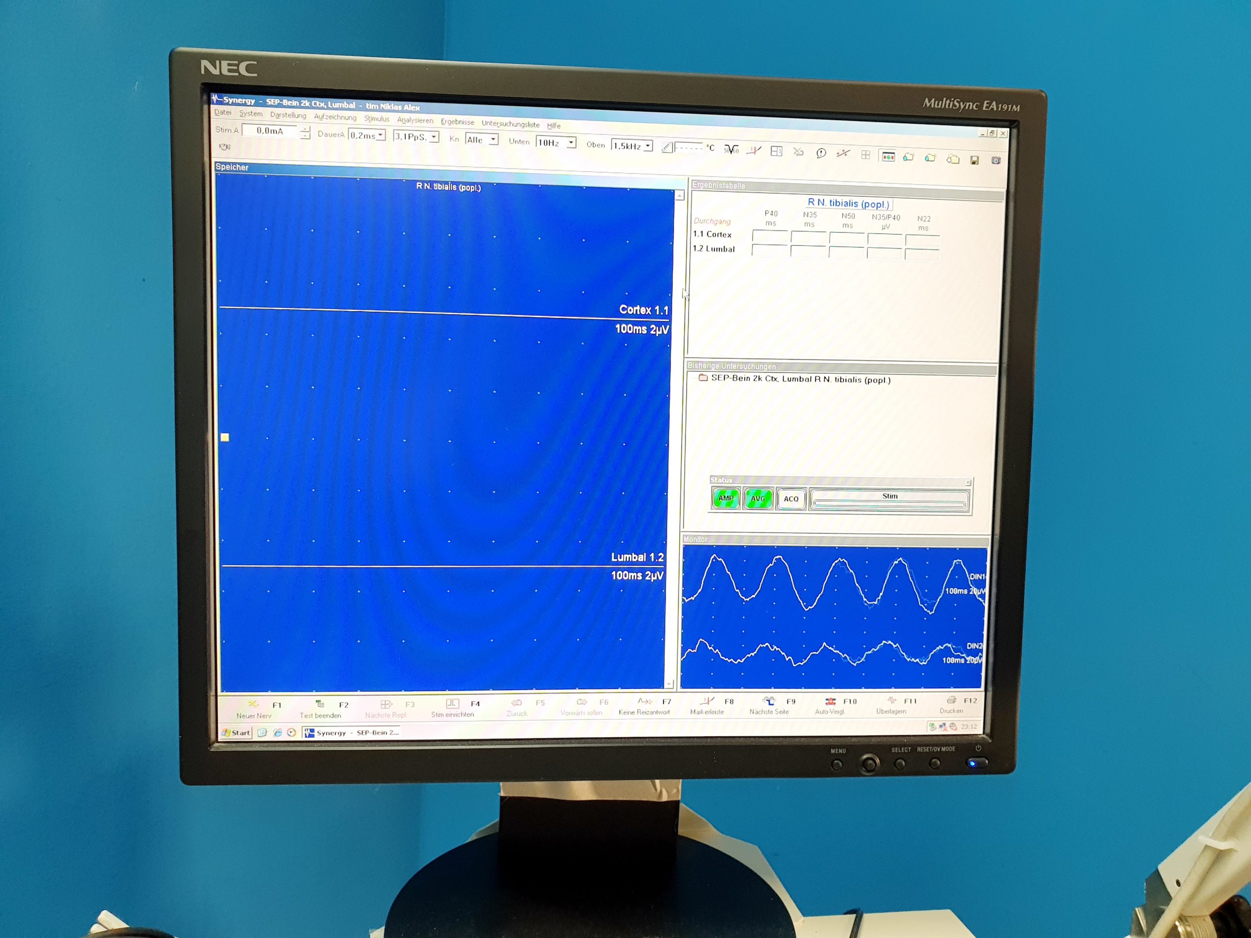 Toennies Viasys Medelec Synergy Neuroscreen EMG thumbnail 12