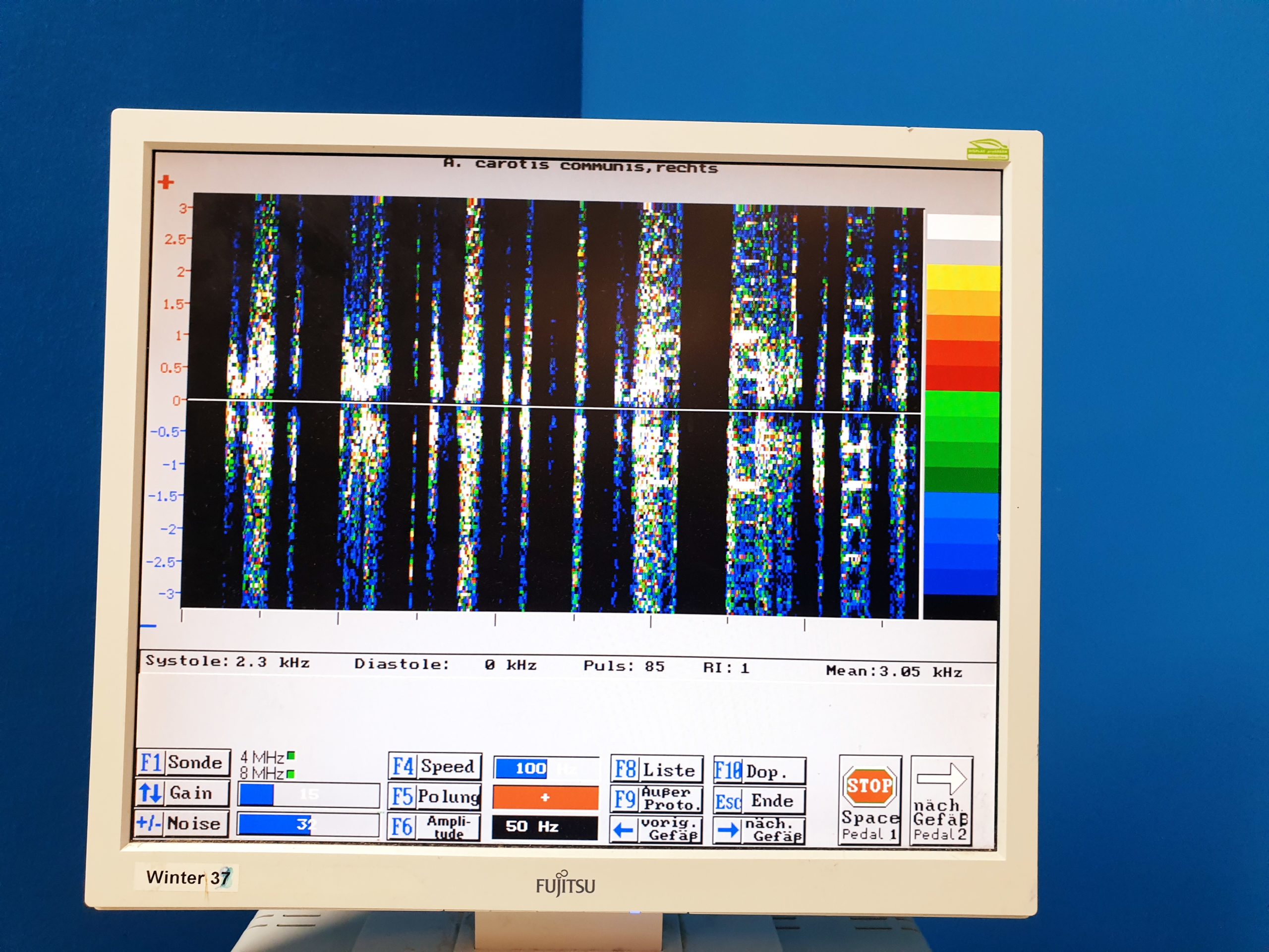 SPEAD Angiolab2 / DopFlow Flowsoft 3 Intravaskuläres Ultraschallsystem mit 2Mhz, 8Mhz thumbnail 14