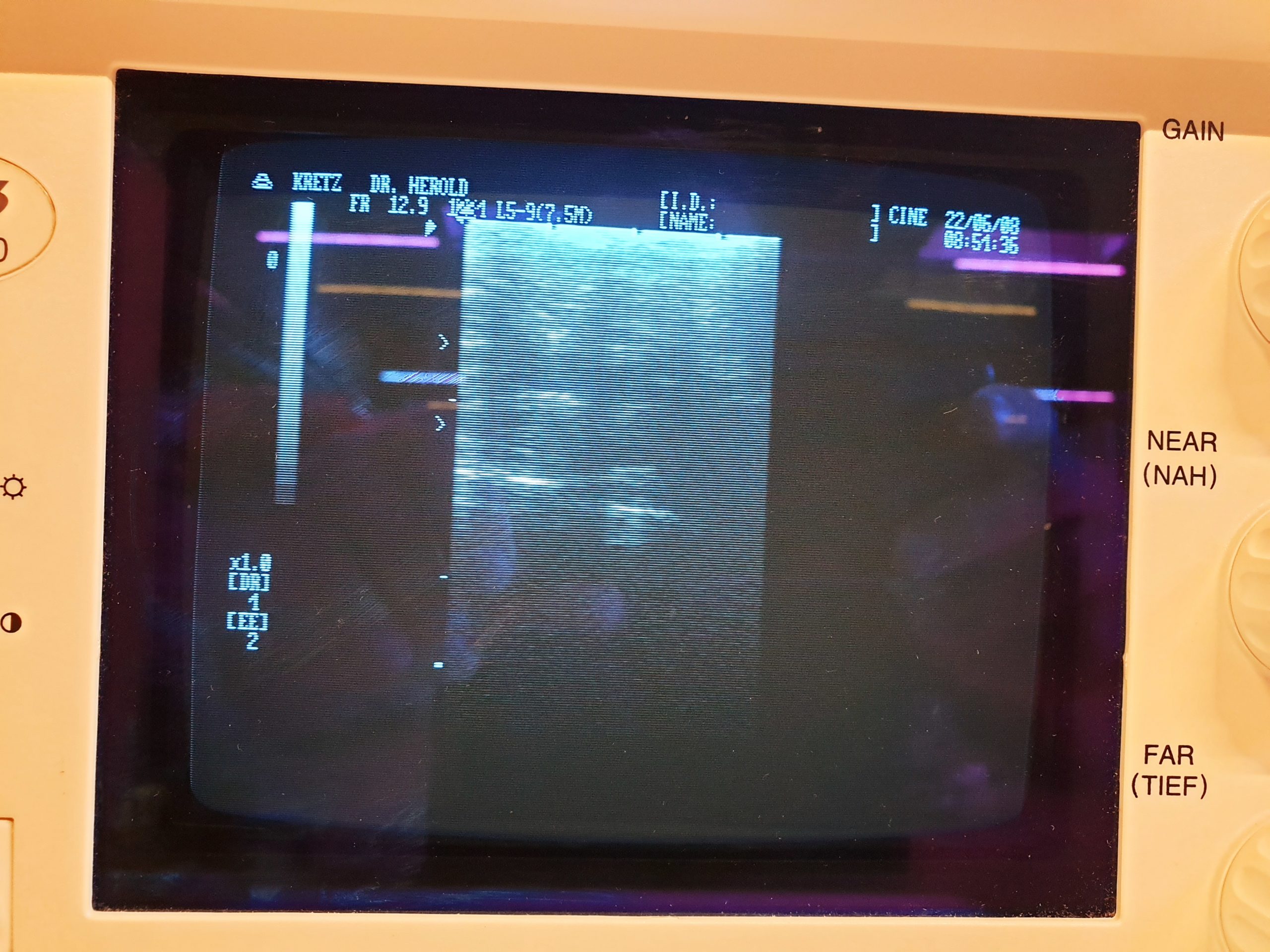 Samsung MEDISON SA600 – SA 600 + L5-9 Linear Sonde thumbnail 3