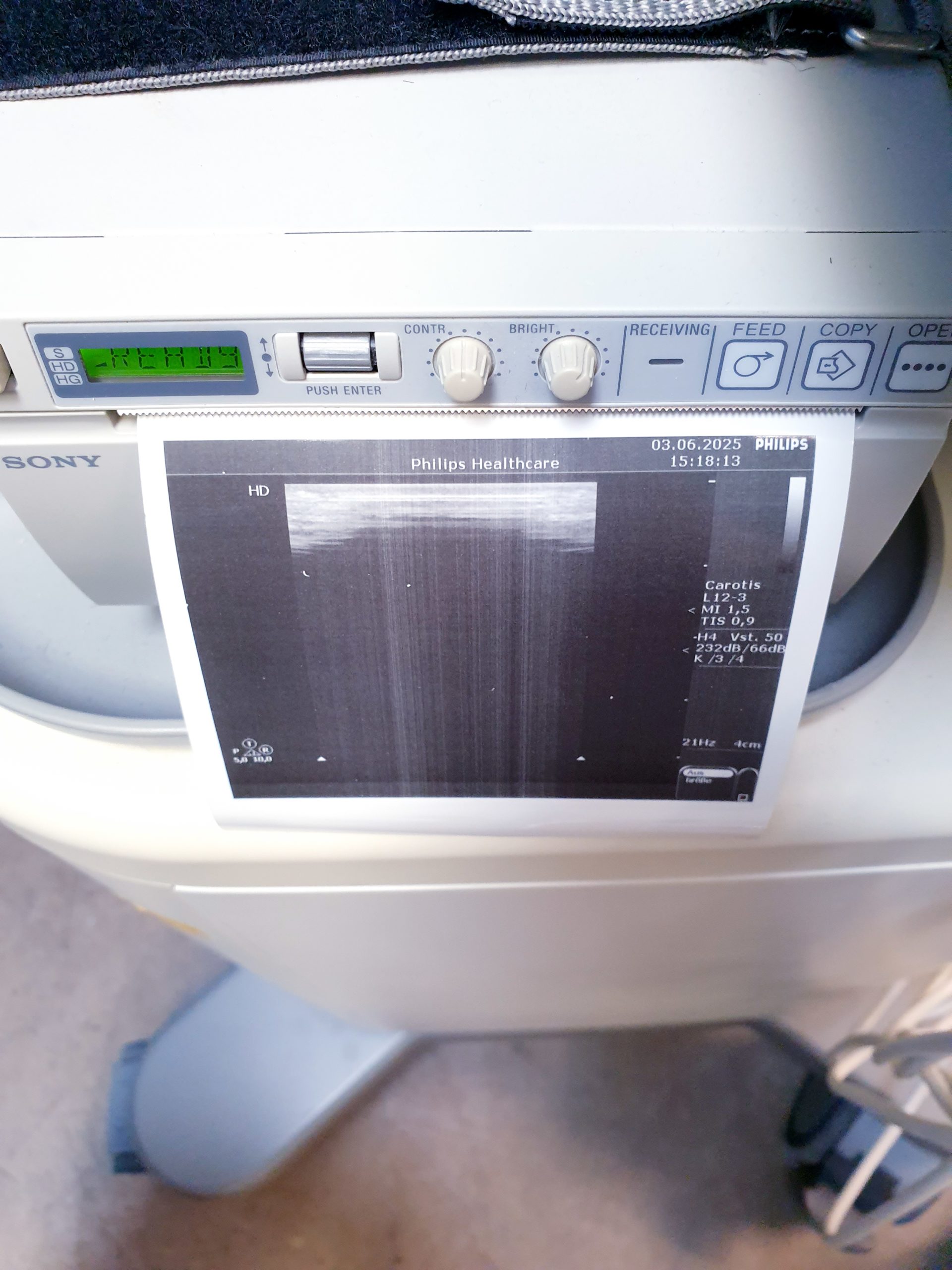 Philips HD 5 HD5 + C5-2 + C8-4v + L12-3 – Gynmaschine Farbdoppler thumbnail 13
