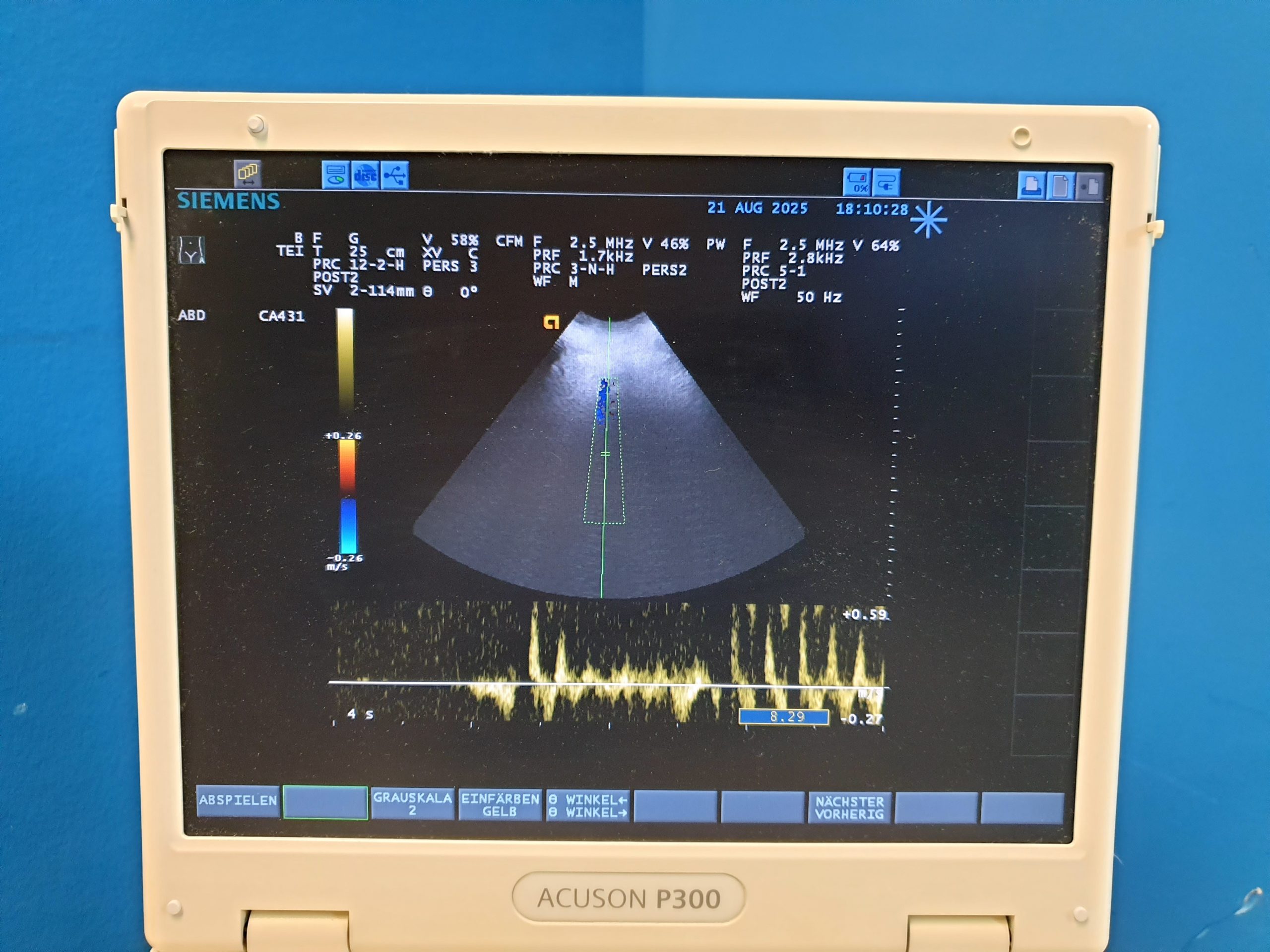 Siemens Acuson P300 P 300 – CA431 – PA230 – LA435 Tragbar Farbdoppler – Doppler thumbnail 3