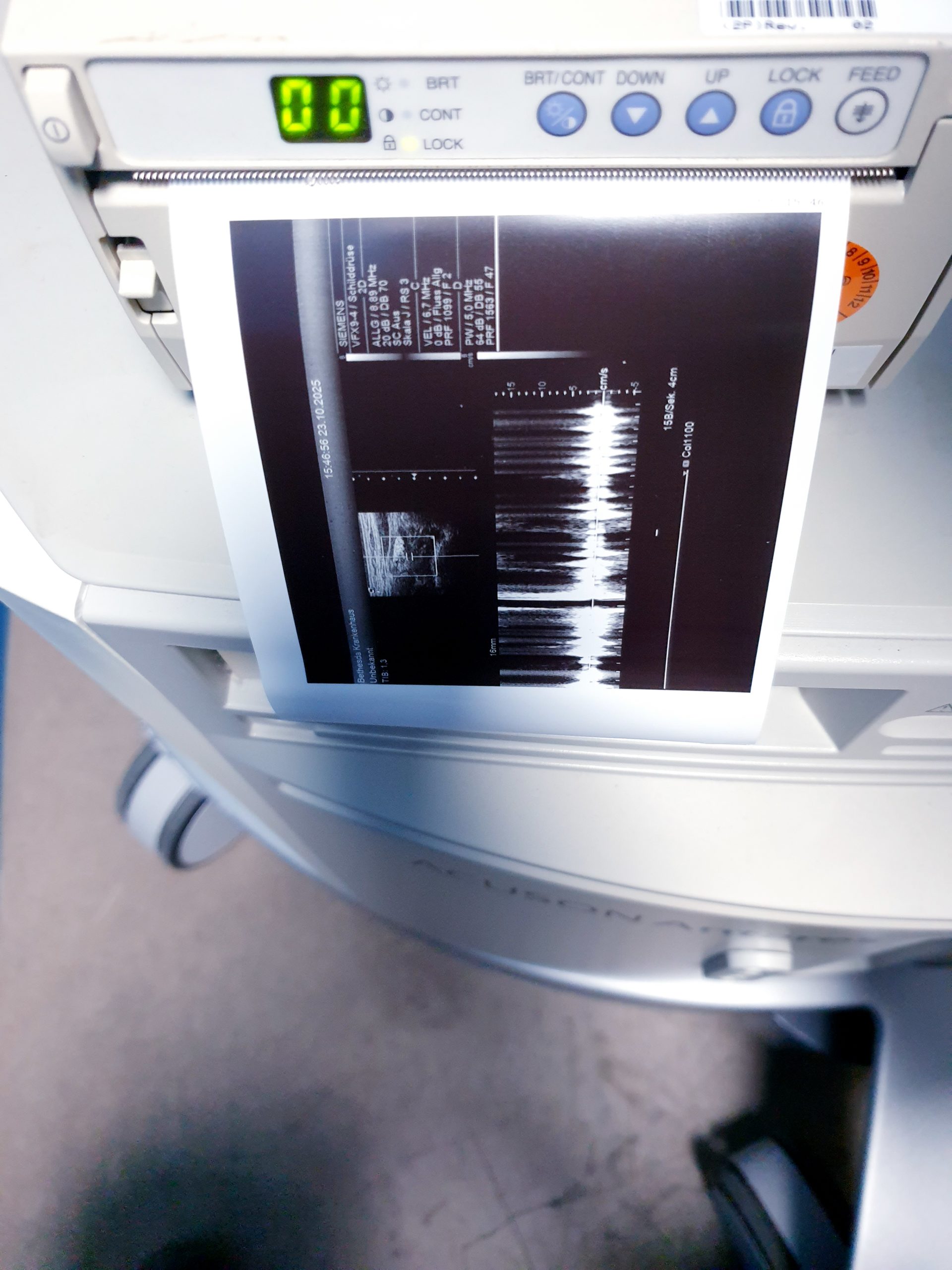 Siemens Acuson Antares Ultraschall Gerät mit 3 Sonden CH4-1 + PX4-1 + VFX9-4 thumbnail 5
